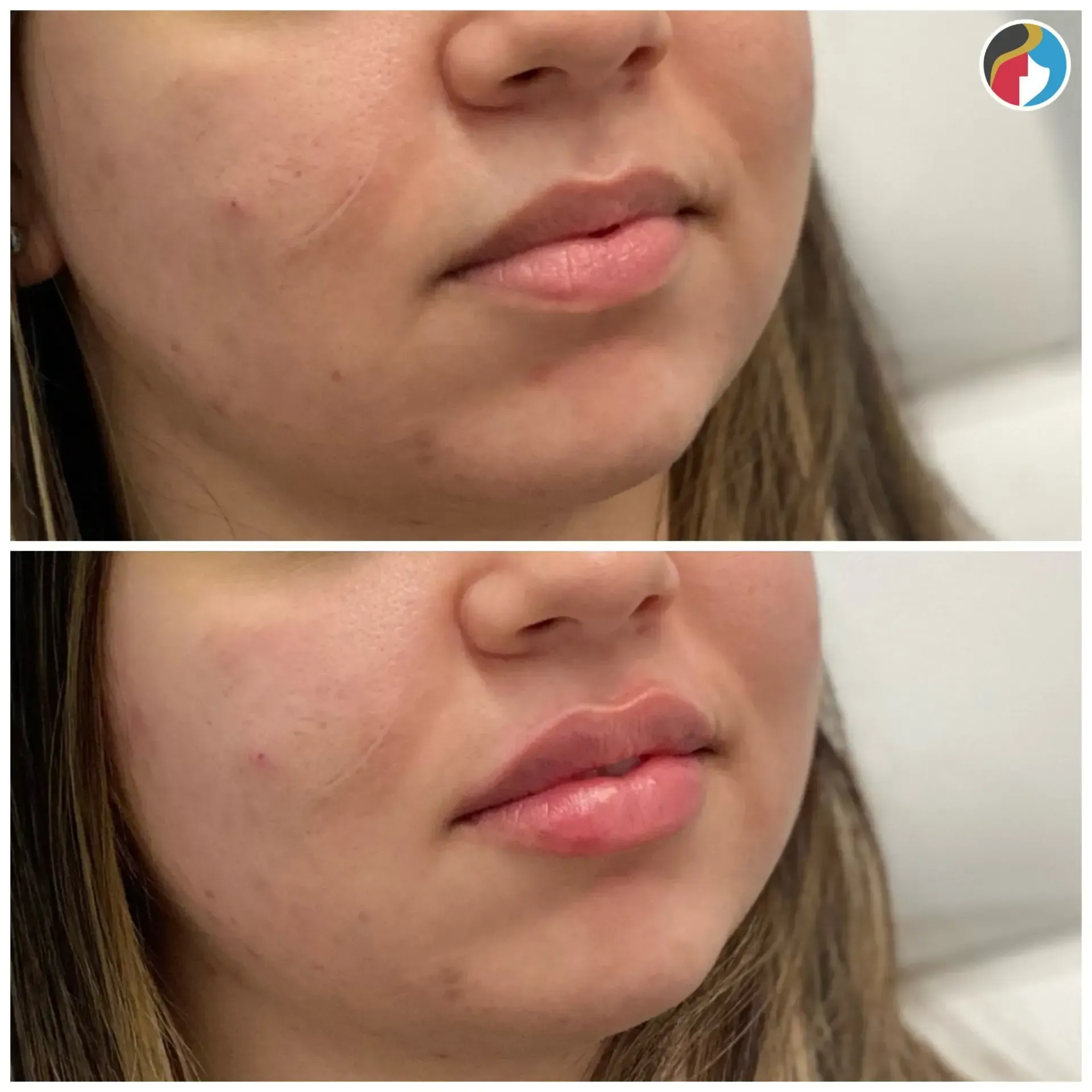Lip Filler in Syracuse, New Hartford, and Albany, NY