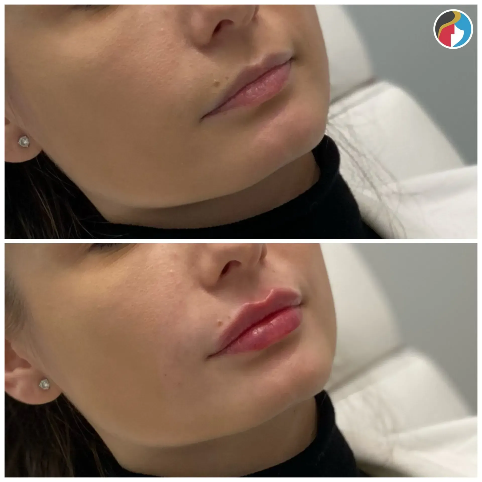 Lip Filler in Syracuse, New Hartford, and Albany, NY
