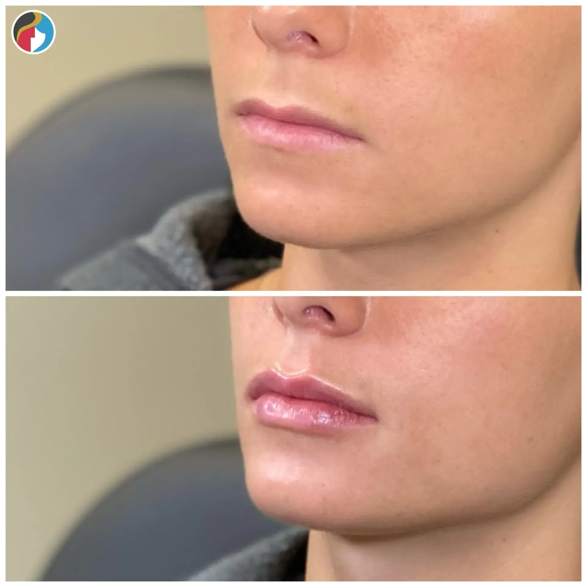 Lip Filler in Syracuse, New Hartford, and Albany, NY