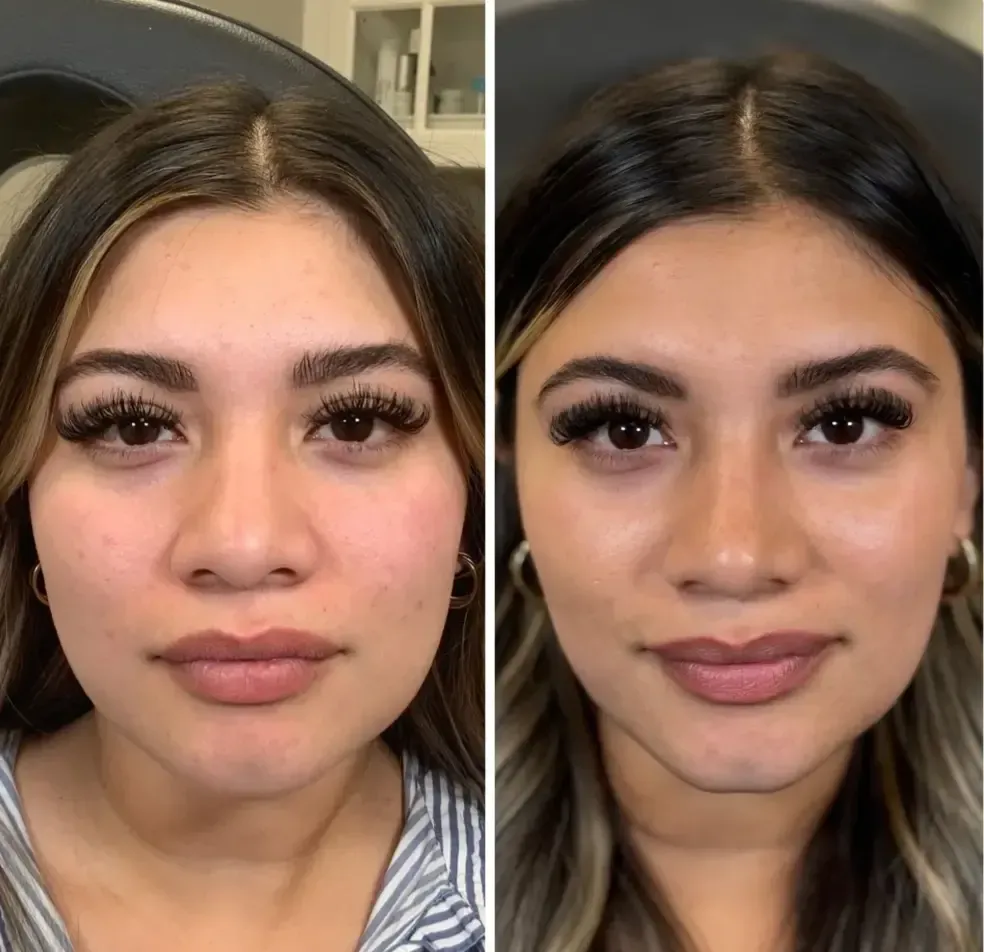 Cosmelan Treatment at Rejuvn8