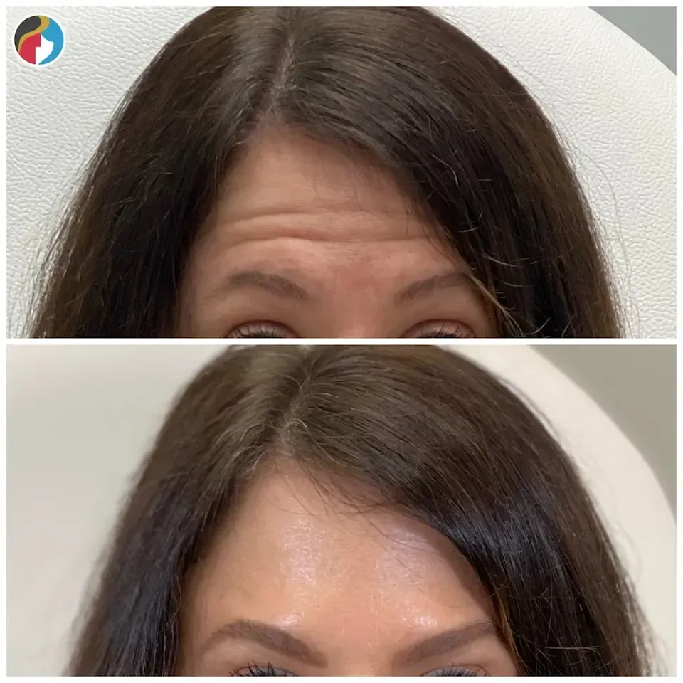 Botox Results Botox in Syracuse, New Hartford, and Albany, NY