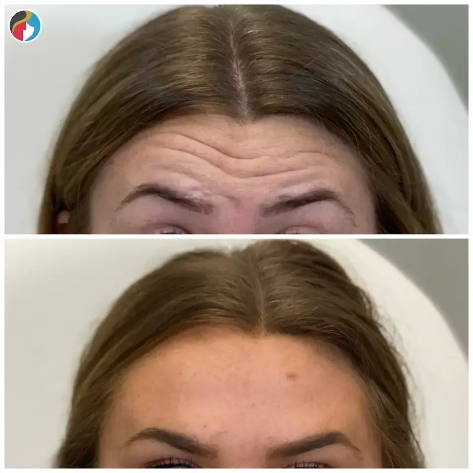 Botox Results Botox in Syracuse, New Hartford, and Albany, NY