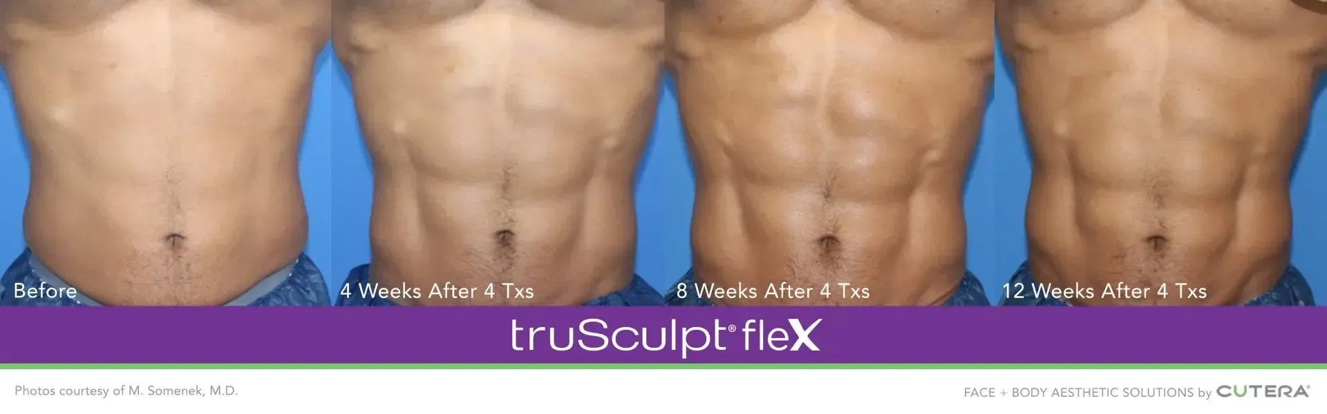 truSculpt flex body sculpting in Syracuse