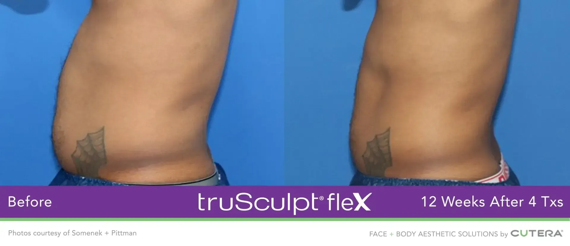 truSculpt flex body sculpting in New Hartford