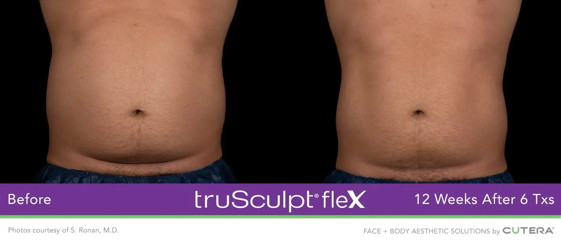 body sculpting in Syracuse and in New Hartford
