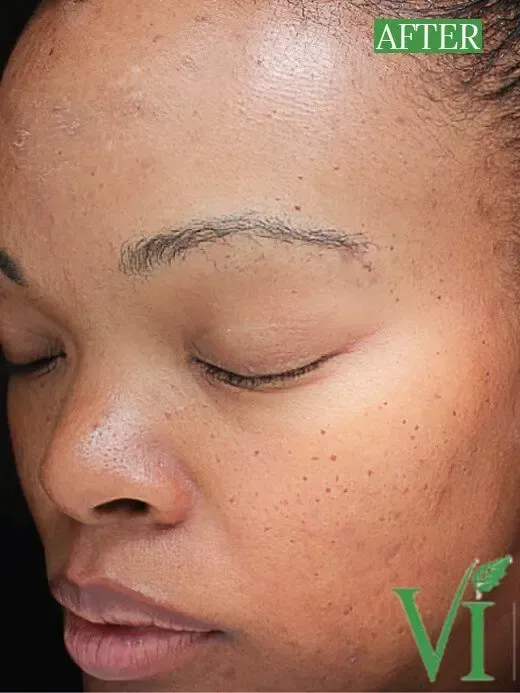 Skin Peel Results Chemical Peel Before and After