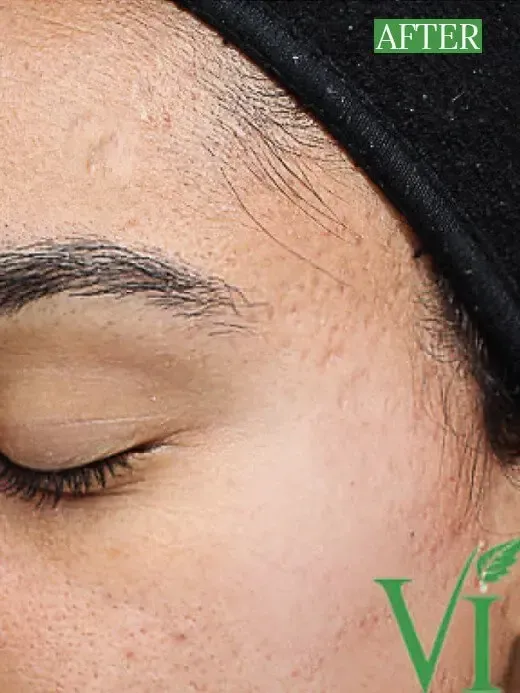 Chemical Peels in Albany, Syracuse, New Hartford, Utica