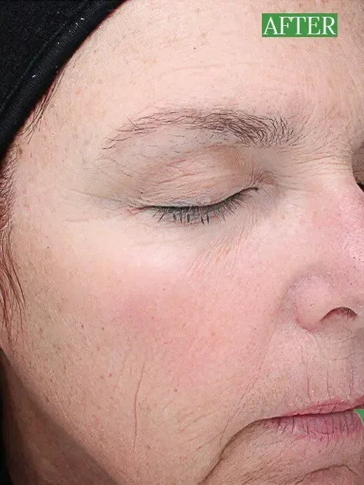 Chemical peel treatment at Rejuvn8