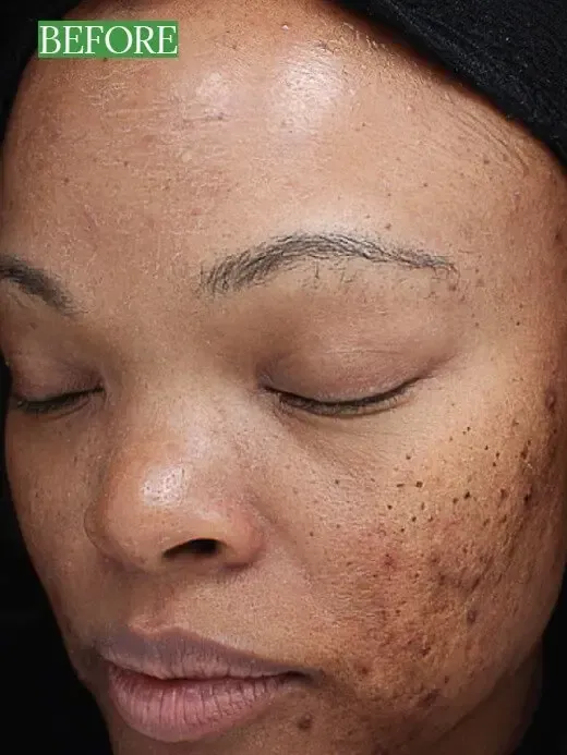 Chemical peels in New Hartford, Syracuse, Albany, and Utica, NY