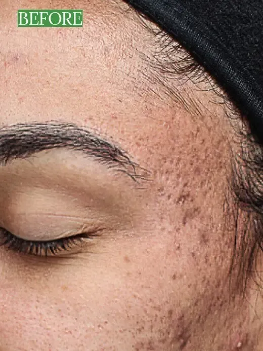 Skin Peel Results Chemical Peel Before and After