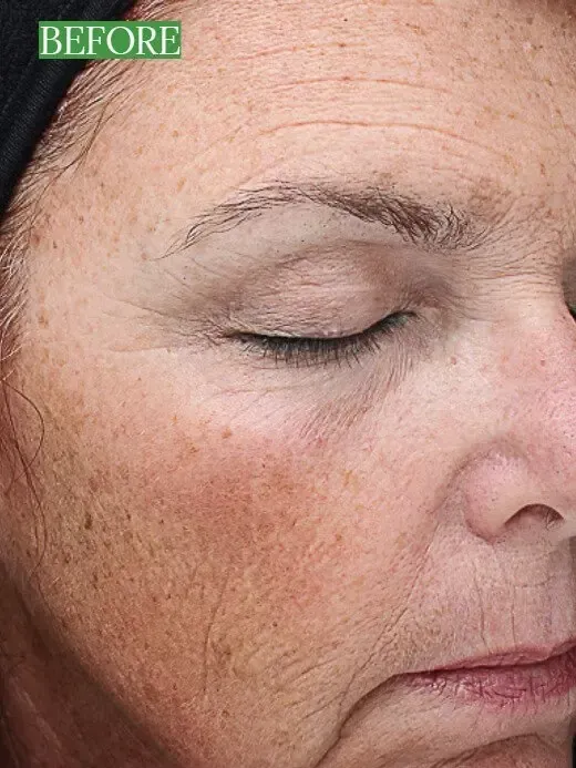 Skin Peel Results Chemical Peel Before and After