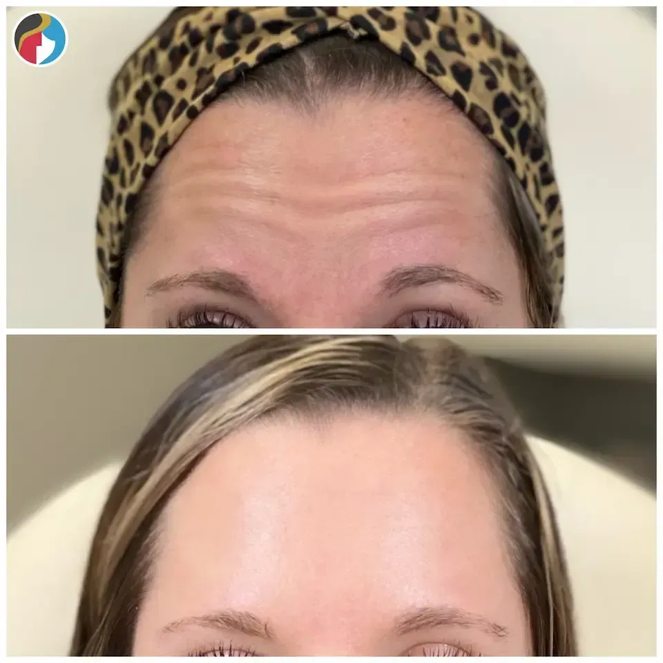 Forehead Wrinkle Relaxer Botox in Syracuse, New Hartford, and Albany, NY