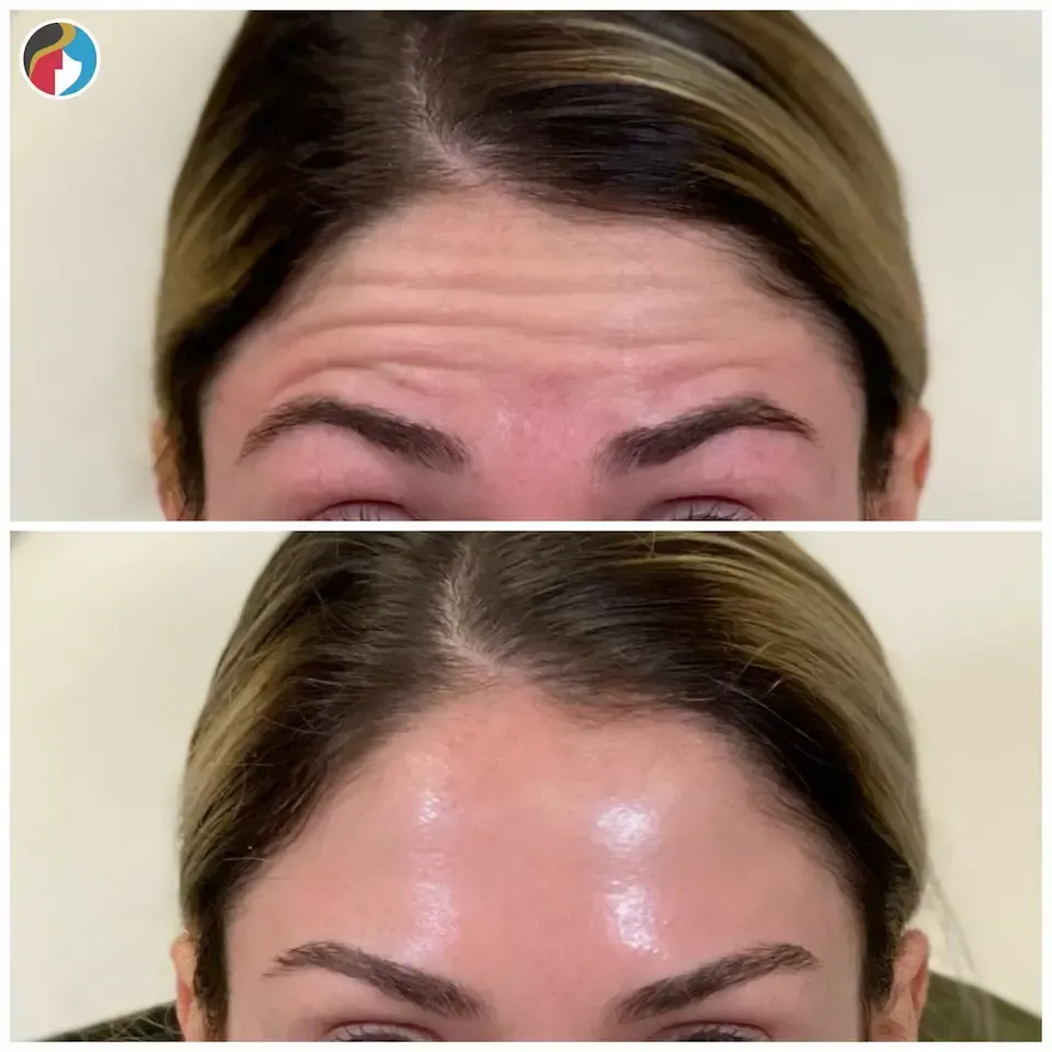 Botox Results Botox in Syracuse, New Hartford, and Albany, NY
