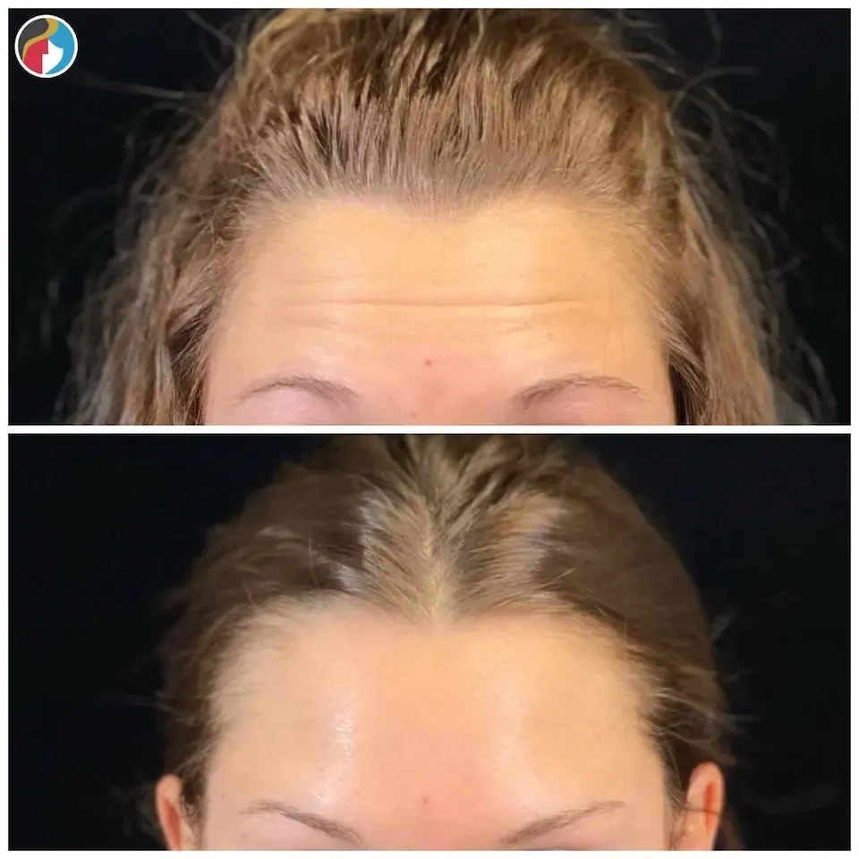 Botox Results Botox in Syracuse, New Hartford, and Albany, NY