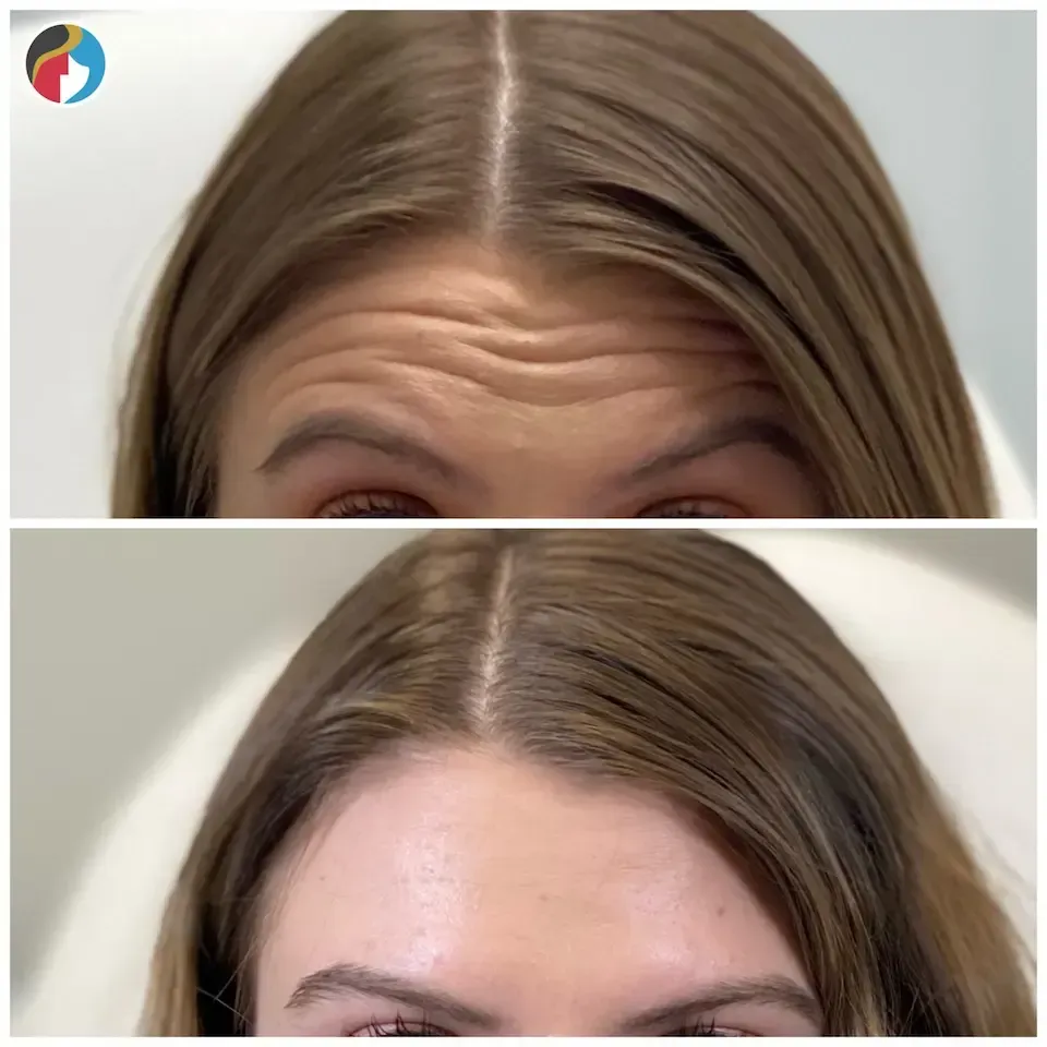 Botox Results Botox in Syracuse, New Hartford, and Albany, NY