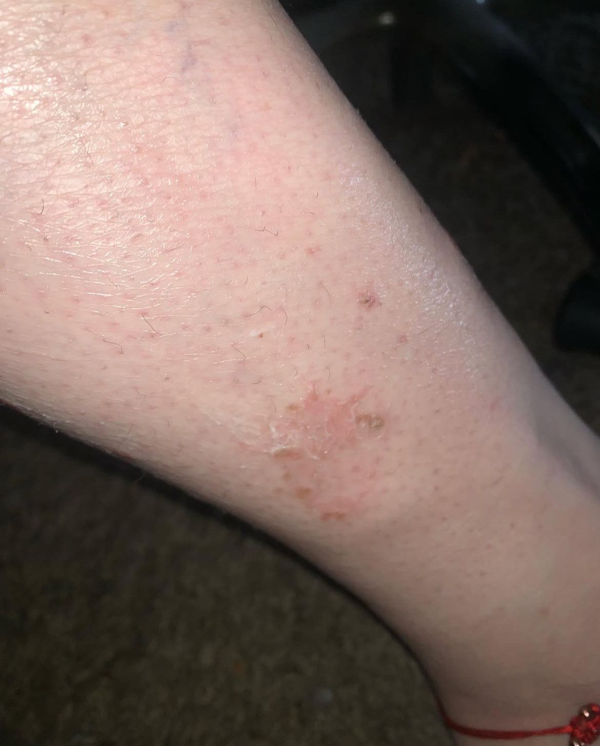 A close up of a person 's leg with a rash on it.