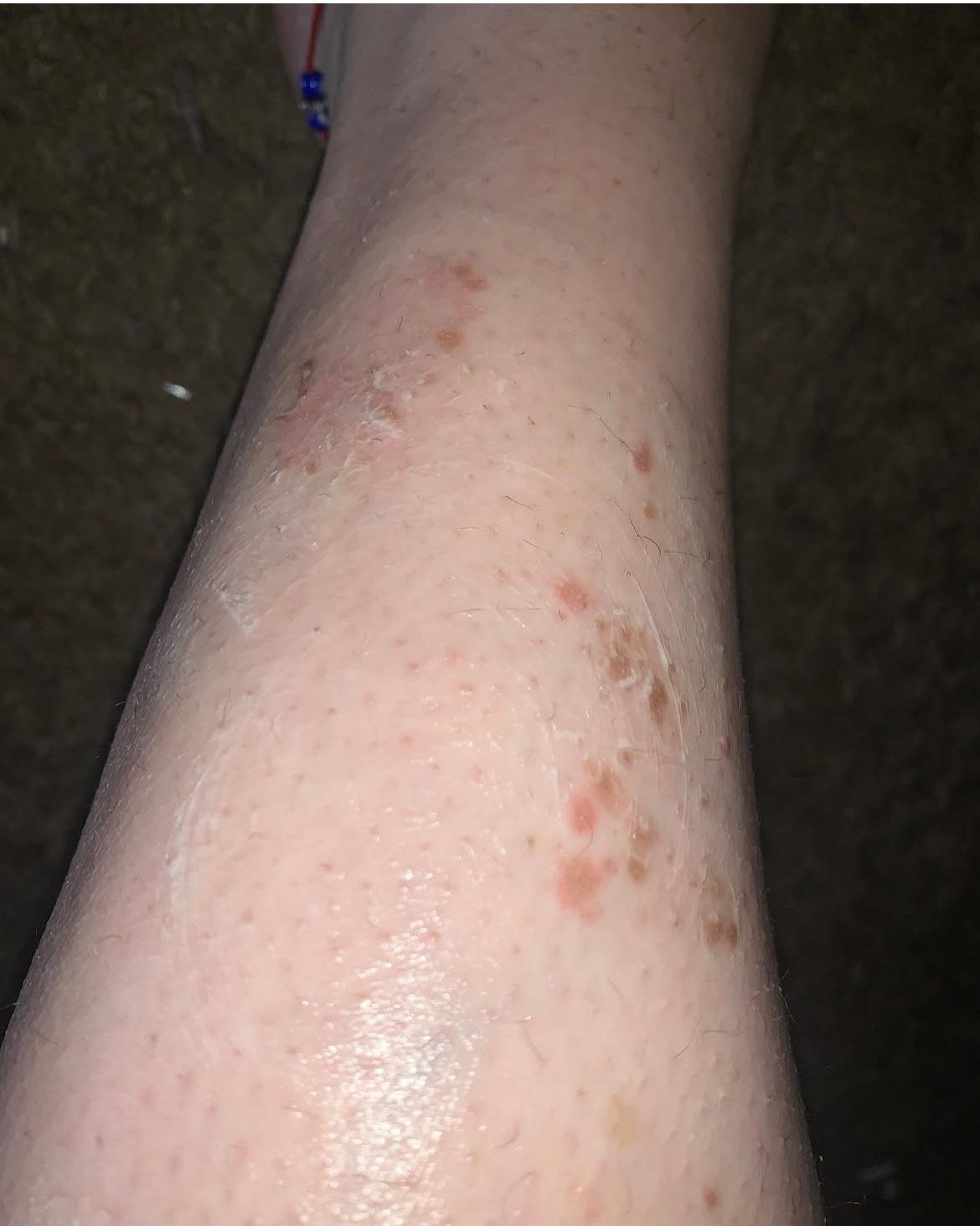 A close up of a person 's leg with red spots on it.
