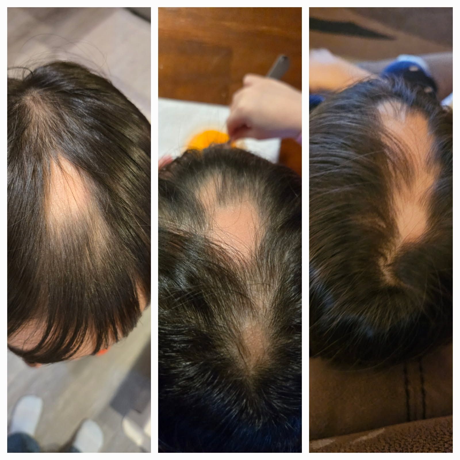 A collage of three pictures of a child 's head with a bald spot on it.