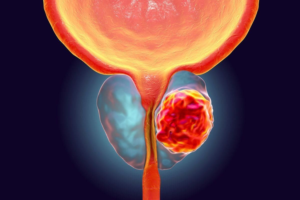 biopsia-da-prostata-como-funciona-dr-antonio-rocha-junior-urologista-teresina-piaui