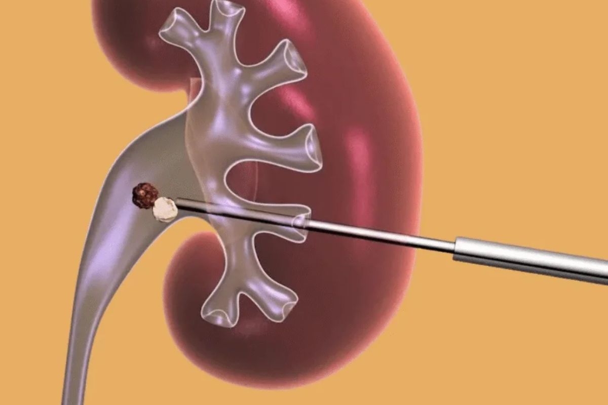 efrolitotomia-percutanea-como-funciona-dr-antonio-rocha-junior-urologista-teresina-piaui