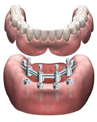 bar over denture implant supported