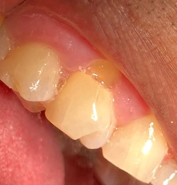 Close-up of teeth with gum line abrasion
