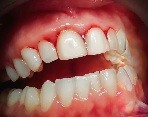 gingivitis