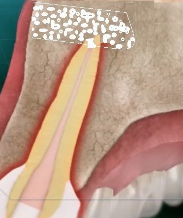 sythetic bone grafting, apicoectomy 