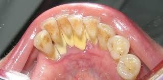 heavy calculs on lower teeth