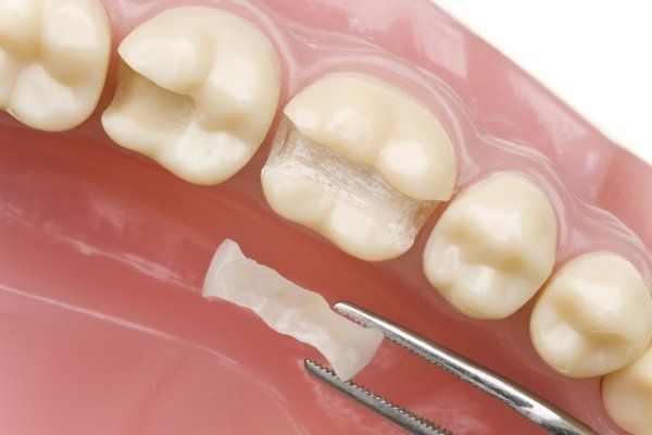 close up of ceramic inlay, castellano dmd. dentist 33578