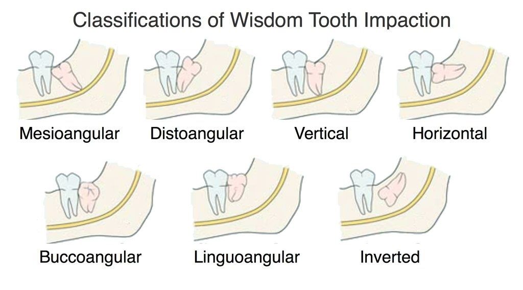 wisdom tooth types and removal castellano, riverview fl. top dentist