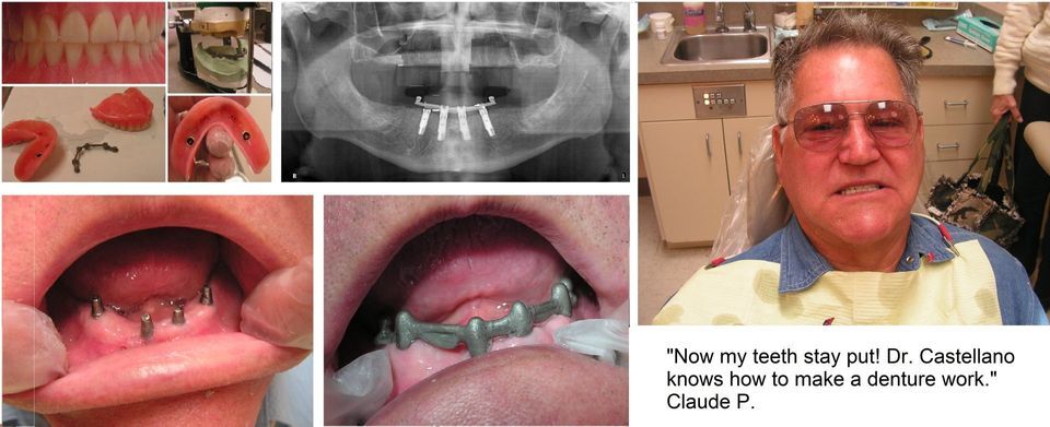 bar overdenture lower castellano
