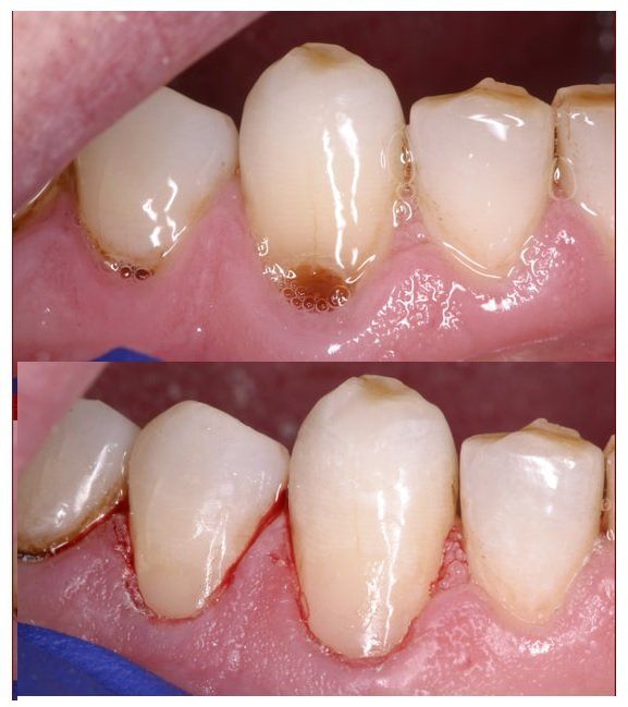 root carries, best dentist riverview, 33578, tooth colored fillings 