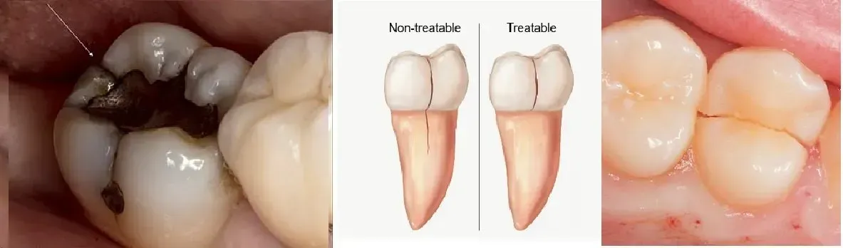 cracked tooth, castellano dmd, top dentist for cracked tooth syndrome