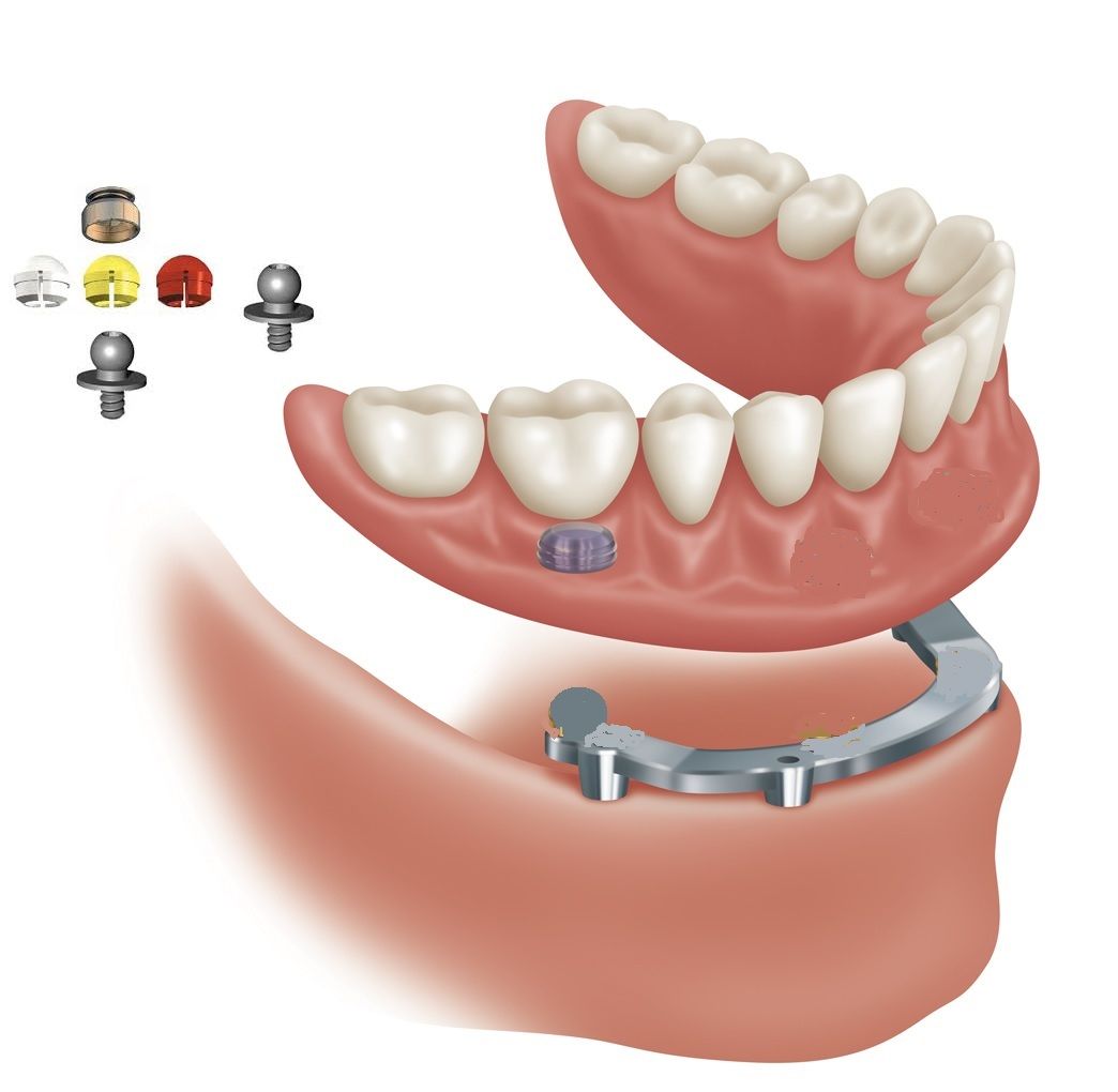 bar over denture art work