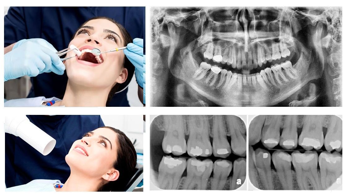 x-rays at dental exam are great tool for locating cavities.Chris Castellano , top cosmetic dentist , Riverview, Fl. 33578