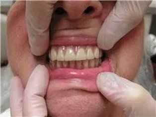 full upper denture over lower ball attcahement lower over denture