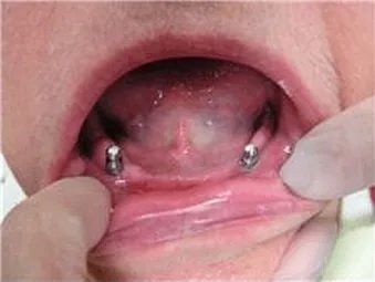 2 implant ball attachment over denture