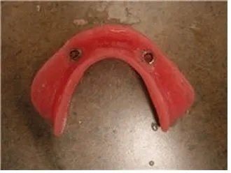 2 implant ball attachment o ring keepers in lower denture
