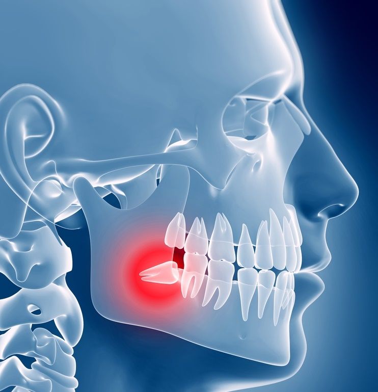 wisdom tooth removal, 3rd molar extraction, saturday, 33578, top dentist riverview fl
