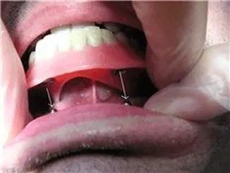 how a ball over denture attaches