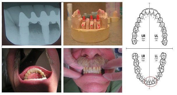 3 implant supported anterior bridge castellano 33578
