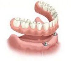 2 implant ball attachment over denture
