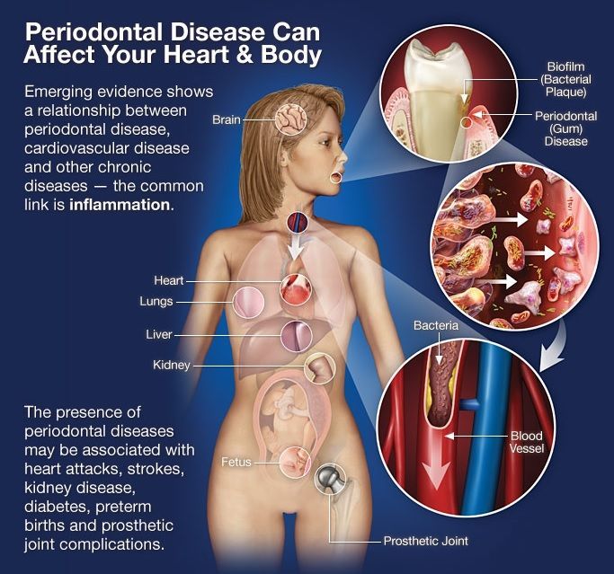 how bacterial endocarditis affects the body. castellano periodontist, dentist, 33578
