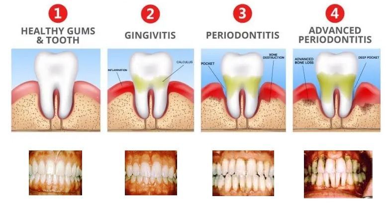 healthy gums to periodonitis