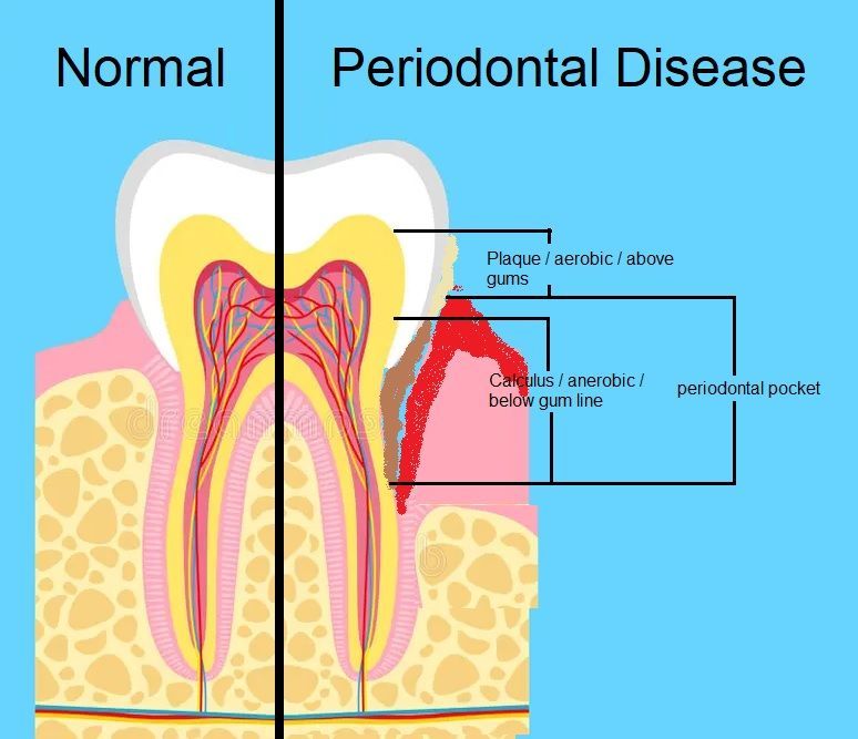 cross section of tooth with detail of periodontal disease. Castellano 33578 top dentist riverview fl