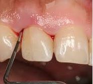 measuring for periodontal disease, top periodontist riverview fl 33578