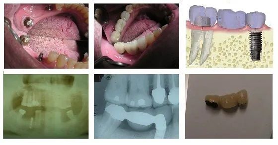 molar to implant bridge castellano