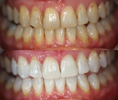 cosmetic bleaching before and after, ZOOM!,  castellano dmd, 33578 top dentist riveview