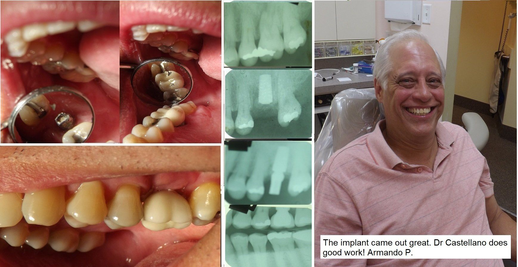 Happy patient with molar implant